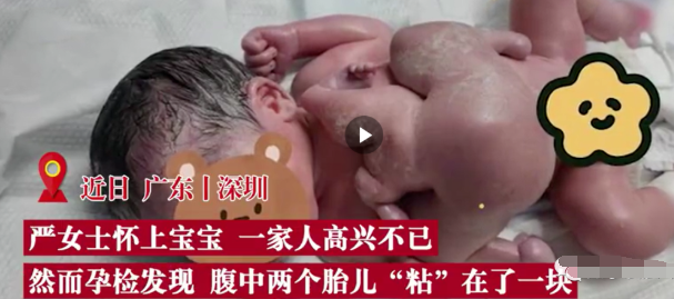 非常罕见，深圳一男婴出生时4只手4只脚